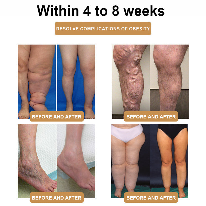 💖💖SCNDR™ Ultrasonic Cellulite Removal and Detoxification Wristband (30% off for a limited time + 👩⚕️doctor's recommendation)